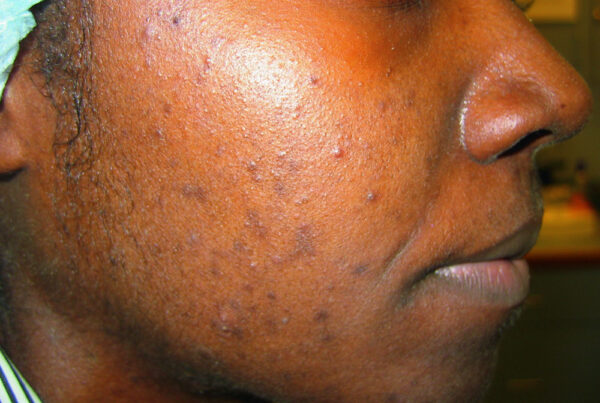 How to Clear Acne Naturally Without Harsh Chemicals